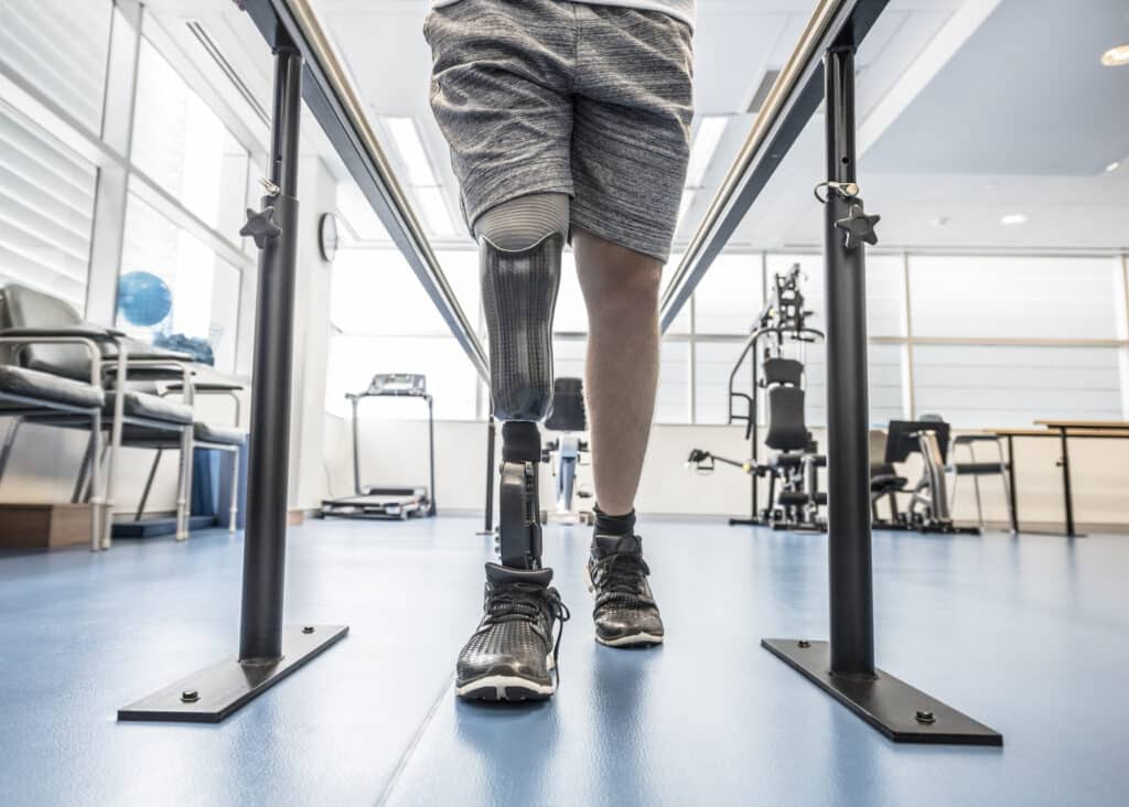 Man with prosthetic leg using parallel bars